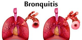 Bronquitis