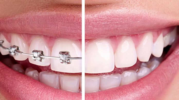 Invisalign