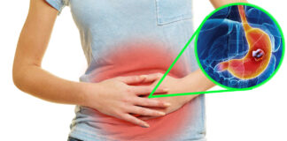 Cáncer de estómago