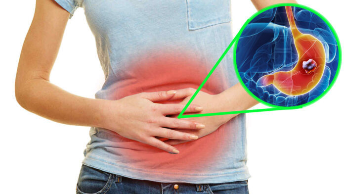 Cáncer de estómago