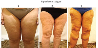 Lipedema