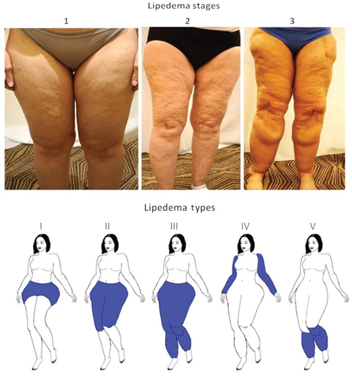 Lipedema