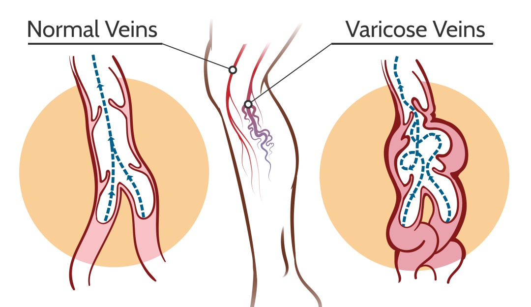 Varices