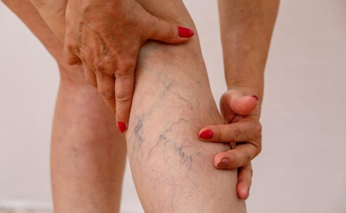 Varices