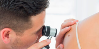 Melanoma