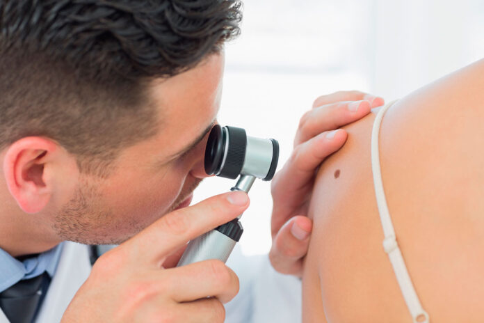 Melanoma