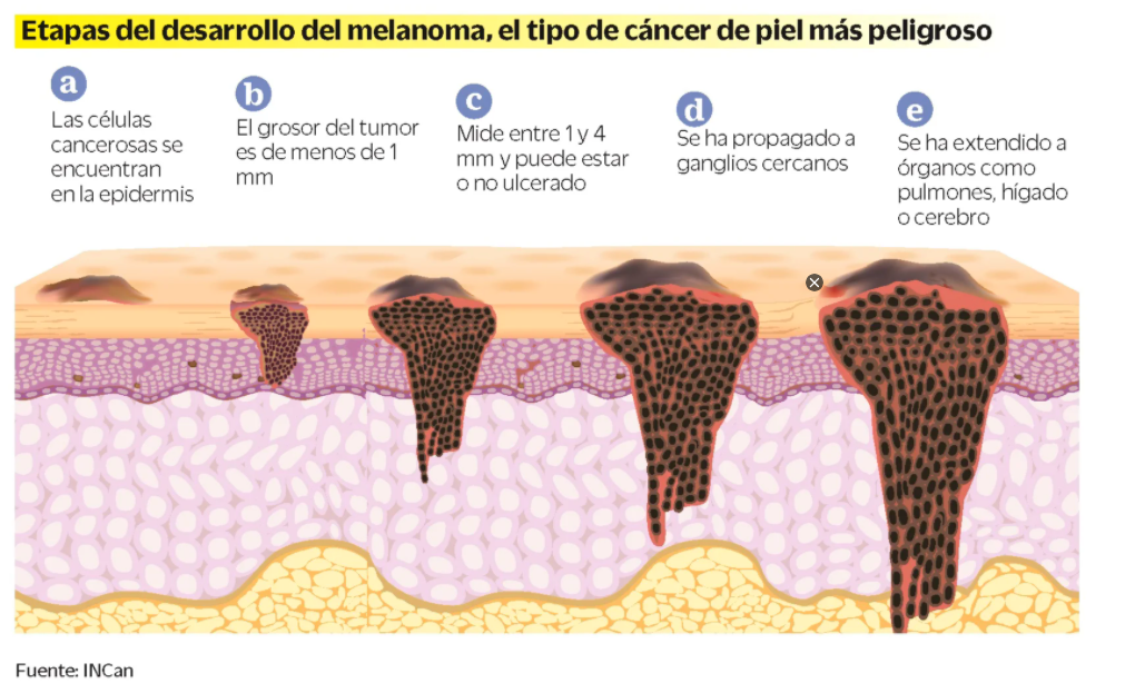 melanoma