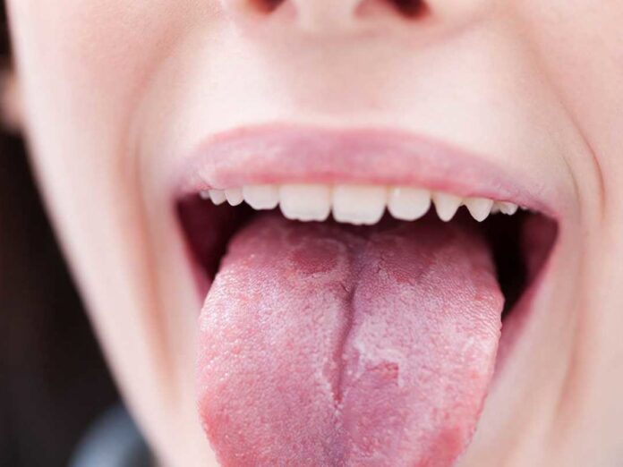 Lengua geográfica, también llamada glositis migratoria benigna
