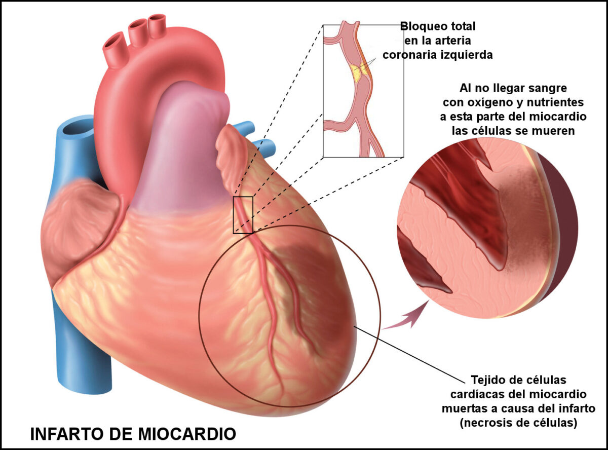 Infarto