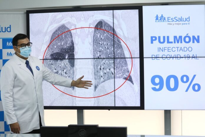 Covid-19 puede afectar pulmones en sólo 5 días