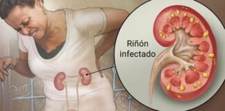 infección renal