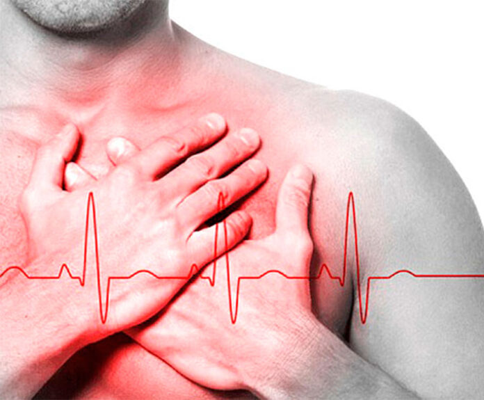 arritmias cardíacas