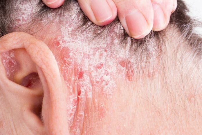 Dermatitis seborreica