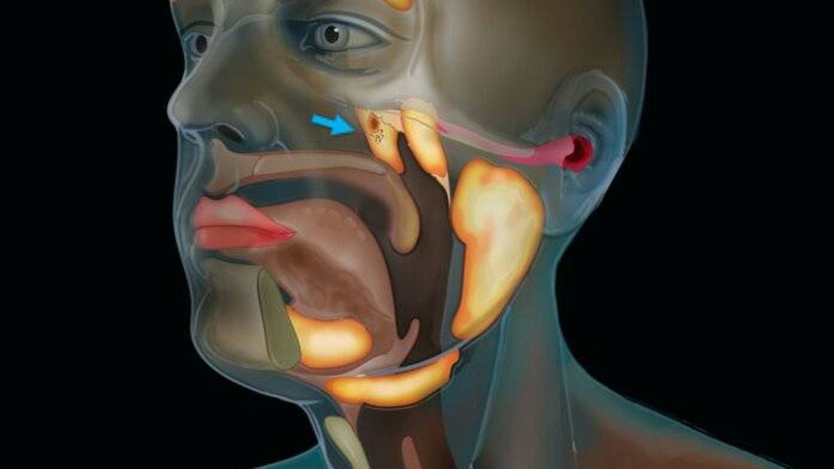 sección coronoide del masetero