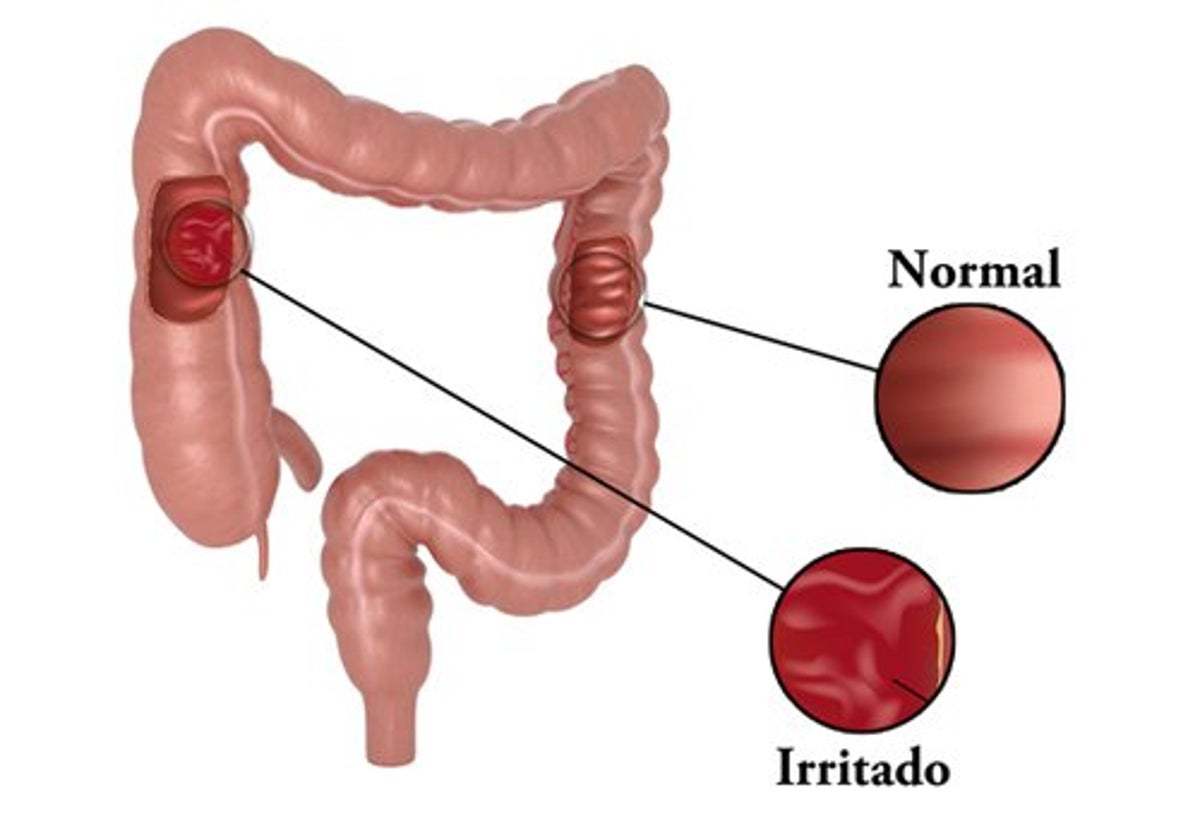 colon irritable