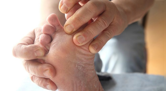 hongos en los pies