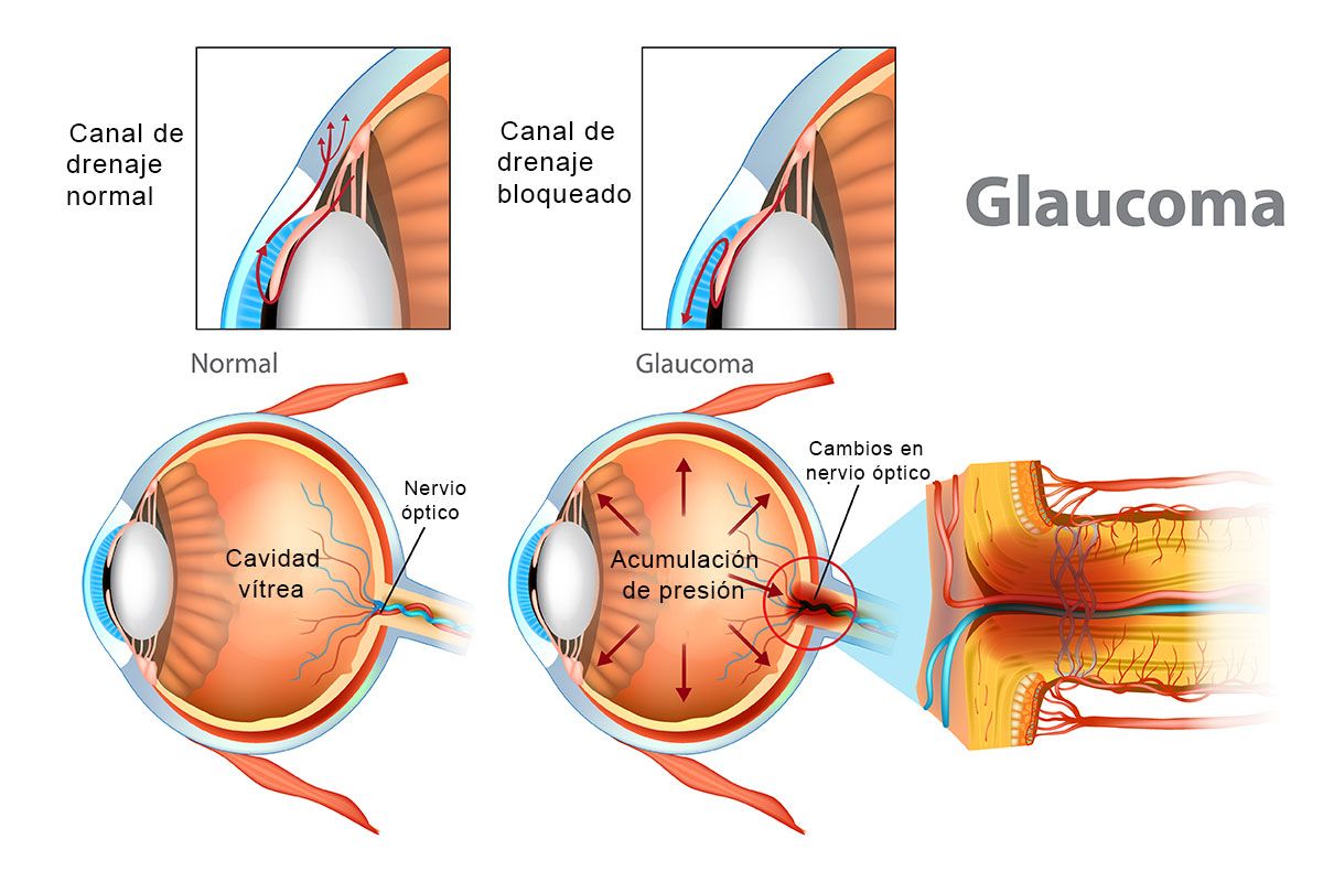 glaucoma