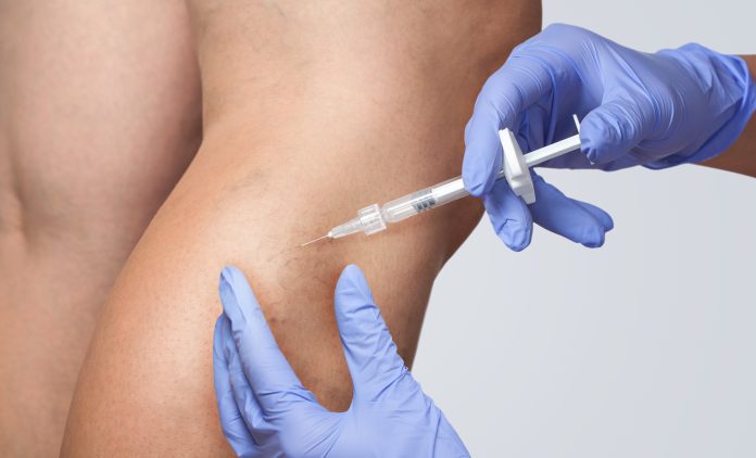 escleroterapia