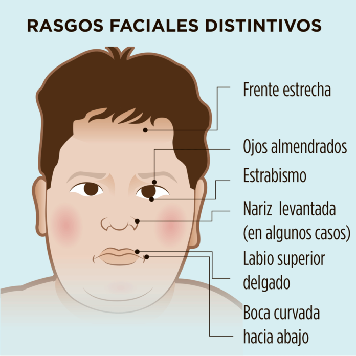 Sindrome de Prader-Willi