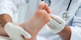 ¿Cómo prevenir los hongos en los pies en verano