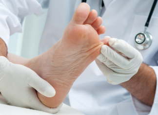 ¿Cómo prevenir los hongos en los pies en verano