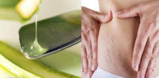 Cómo quitar las estrías de los glúteos con aloe aloe
