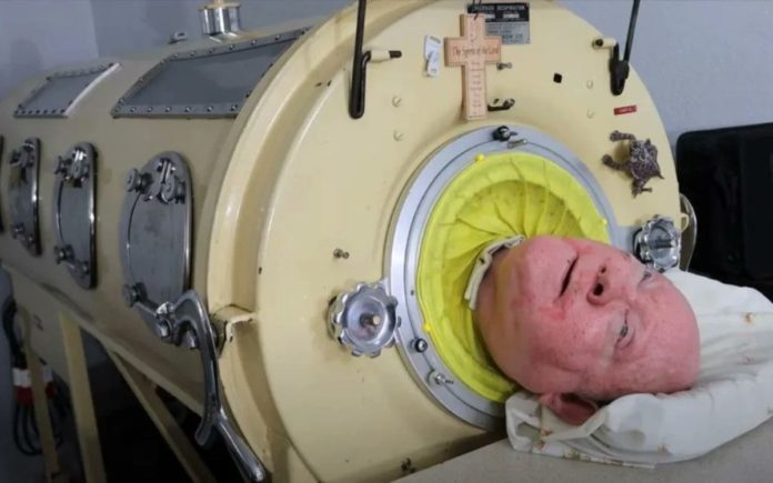 Fallece Paul Alexander quien vivió 70 años en pulmón de acero