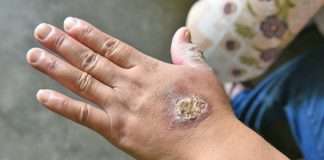 Uta en Lima: aumentan casos de contagio