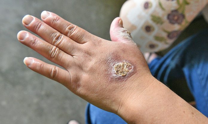 Uta en Lima: aumentan casos de contagio Uta en Lima: aumentan casos de contagio