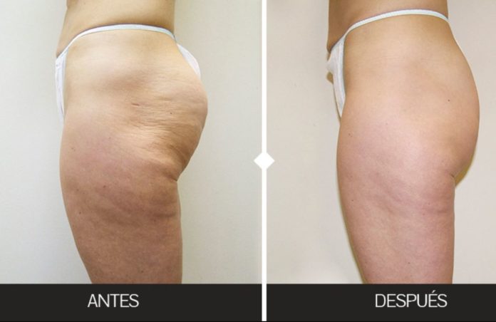 Así te quitas las estrías con almendra y limón