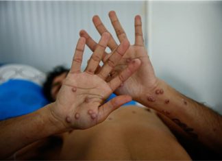 Lima: viruela del mono sigue presente y aumentando
