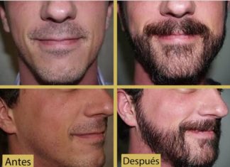 implantes de barba
