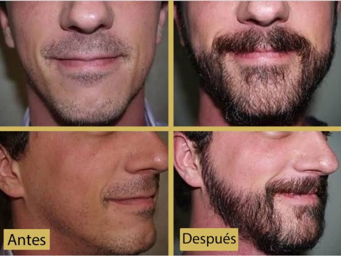 implantes de barba