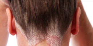 psoriasis