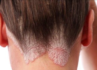 psoriasis