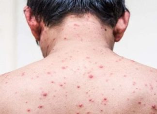OMS declara emergencia sanitaria por viruela del mono