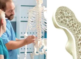 Osteoporosis