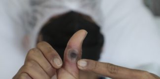 OMS incluye vacuna contra la mpox en su lista de productos seguros y efectivos