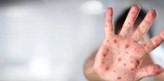 Alemania: Detectan nuevo caso de variante mpox