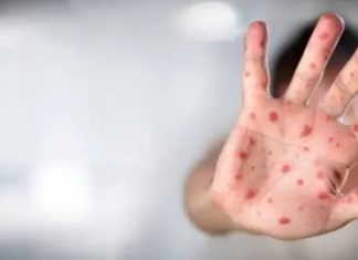 Alemania: Detectan nuevo caso de variante mpox