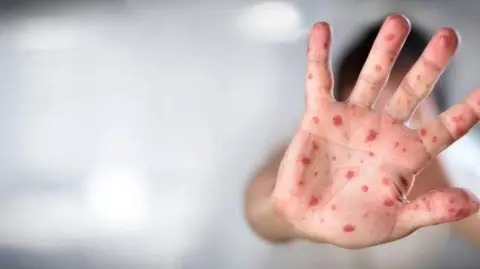 Alemania: Detectan nuevo caso de variante mpox Alemania: Detectan nuevo caso de variante mpox