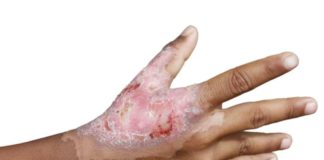 ¿Qué hacer si se queman con cohetes o fuegos artificiales