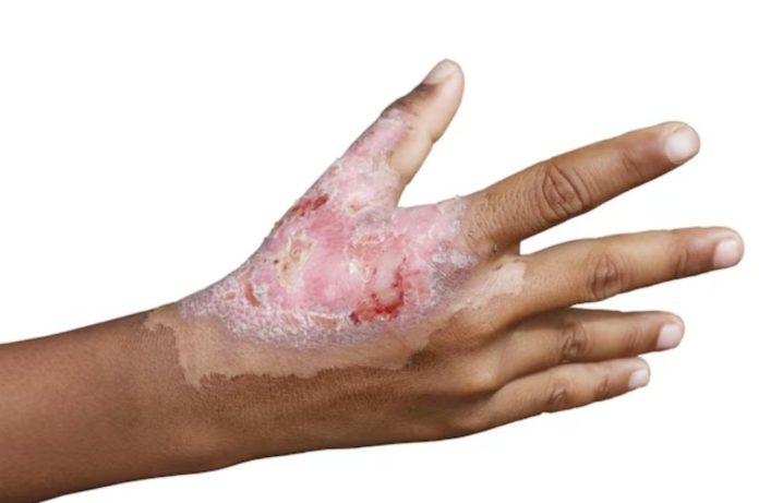 ¿Qué hacer si se queman con cohetes o fuegos artificiales