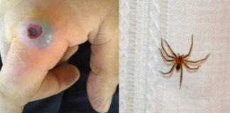 picadura de arañas