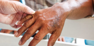 Diresa Piura tras reportarse primer caso de lepra: La capacidad de contagiar del paciente "es básicamente nula"