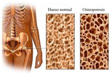 osteoporosis