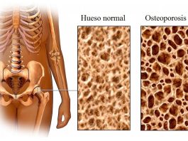 osteoporosis