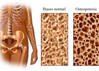 osteoporosis