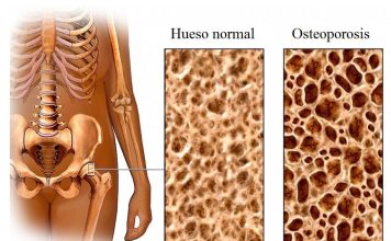¿Sabes cómo puedes frenar el avance la osteoporosis? osteoporosis