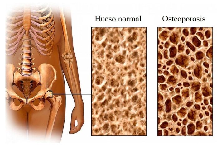 osteoporosis